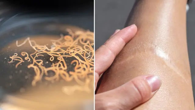 Scar-Free Healing Using Worm Protein Could Transform Wound Treatment